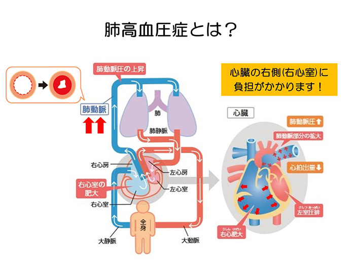 息切れの裏に潜む「見えない心不全」— 2026年、肺高血圧症治療のパラダイムシフトと見過ごされる初期シグナル