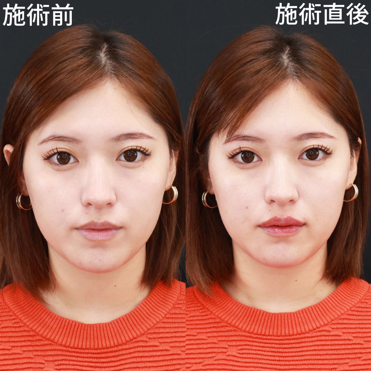 アヒル口の効果を徹底検証｜2026年最新の作り方と印象アップの真実