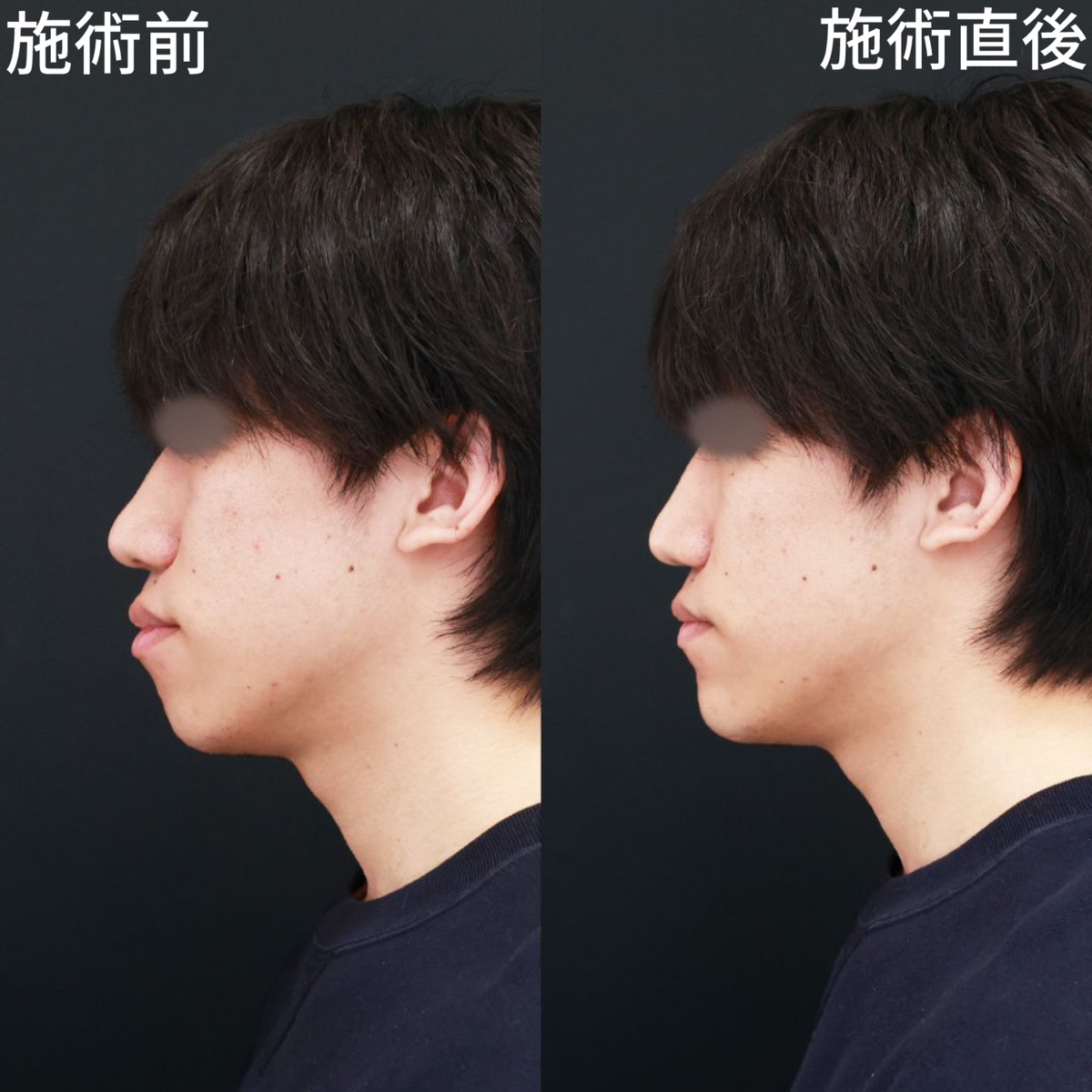 口ゴボ男性はモテない？イケメンとの違いと2026年最新治療の全貌