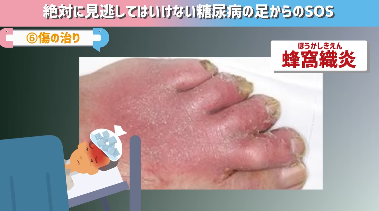 足の指の痒みは糖尿病の初期症状？水虫との違いと壊疽を防ぐ見分け方