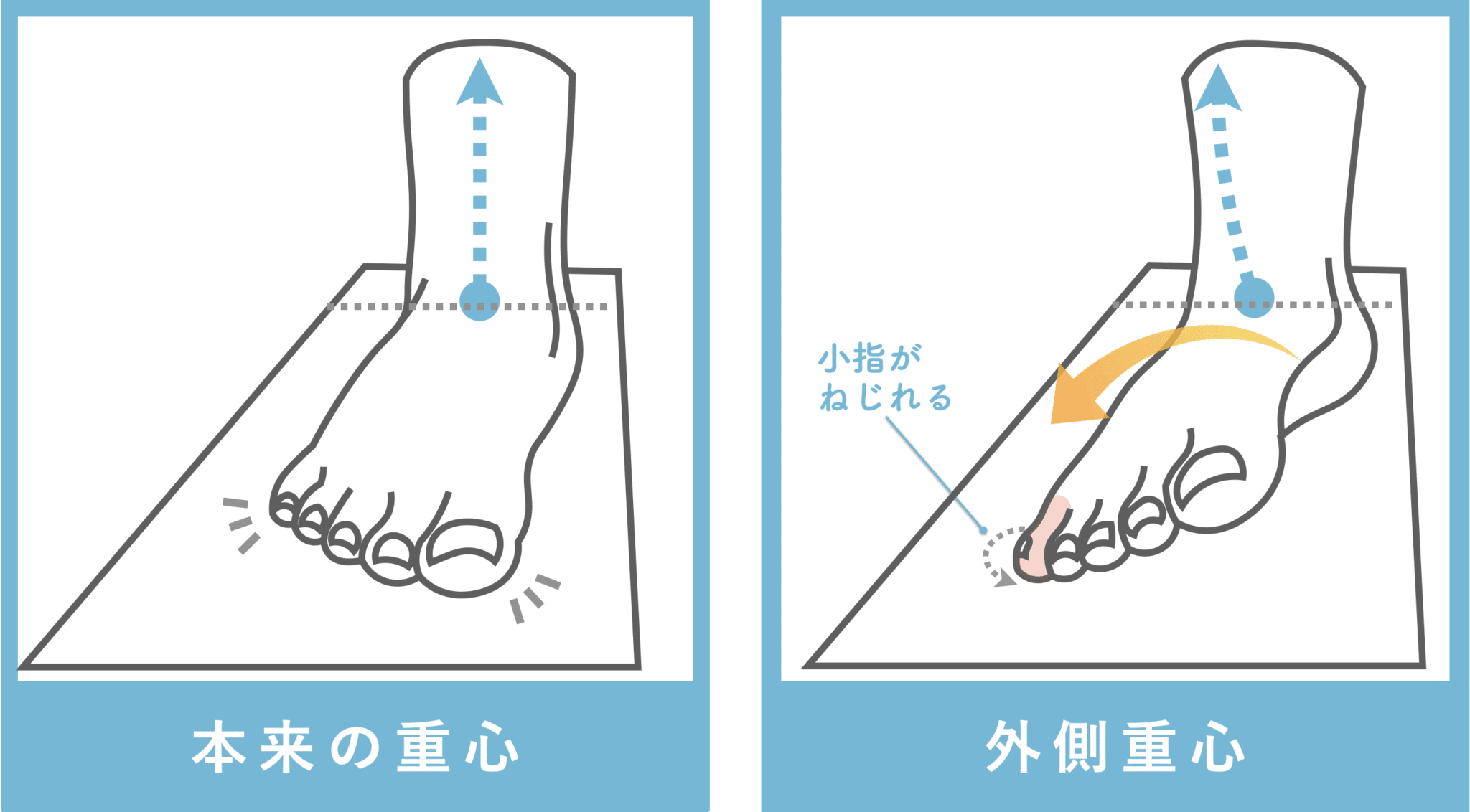 足の小指が倒れる寝指の治し方！放置の危険と自宅改善法【2026年版】