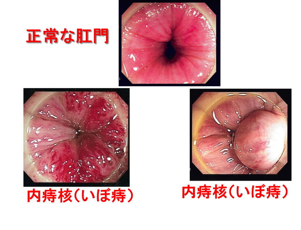 おしりから血が出たらどうする？危険なサインと受診基準を徹底解説