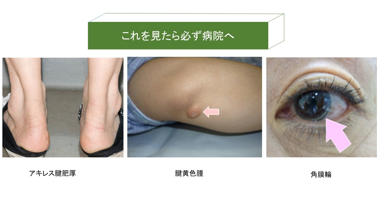 コレステロールが高い人の特徴とは？痩せ型も危ない原因と皮膚のサイン