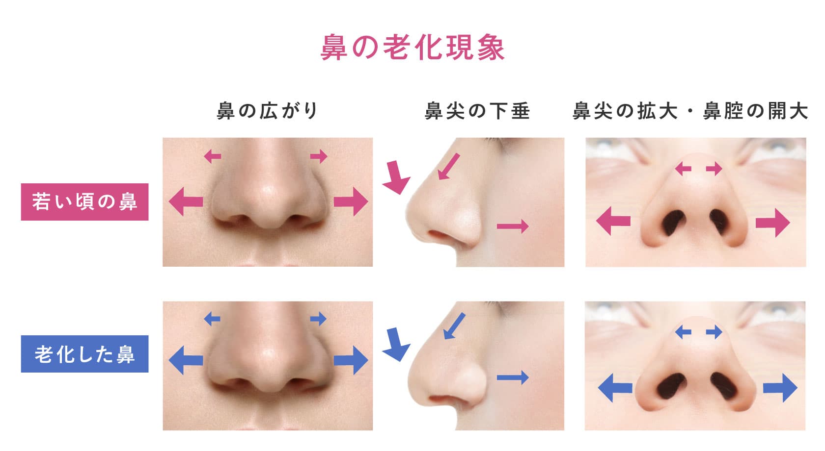 昔より鼻が大きくなった？鼻の肥大化の原因と最新の改善＆予防策
