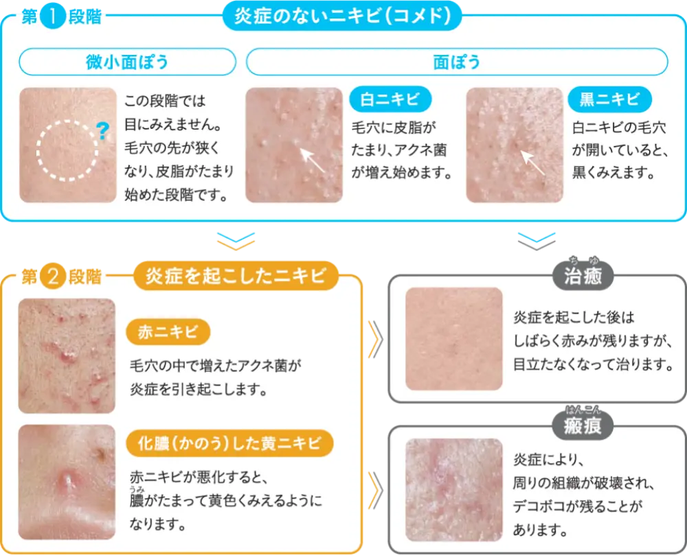 治らない吹き出物の真実｜繰り返す原因と皮膚科学に基づく根本改善策