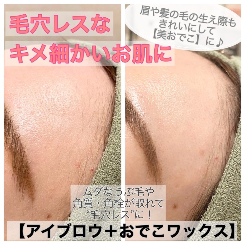 顔ワックス脱毛の真実！肌荒れと効果の検証＆失敗しない完全ガイド