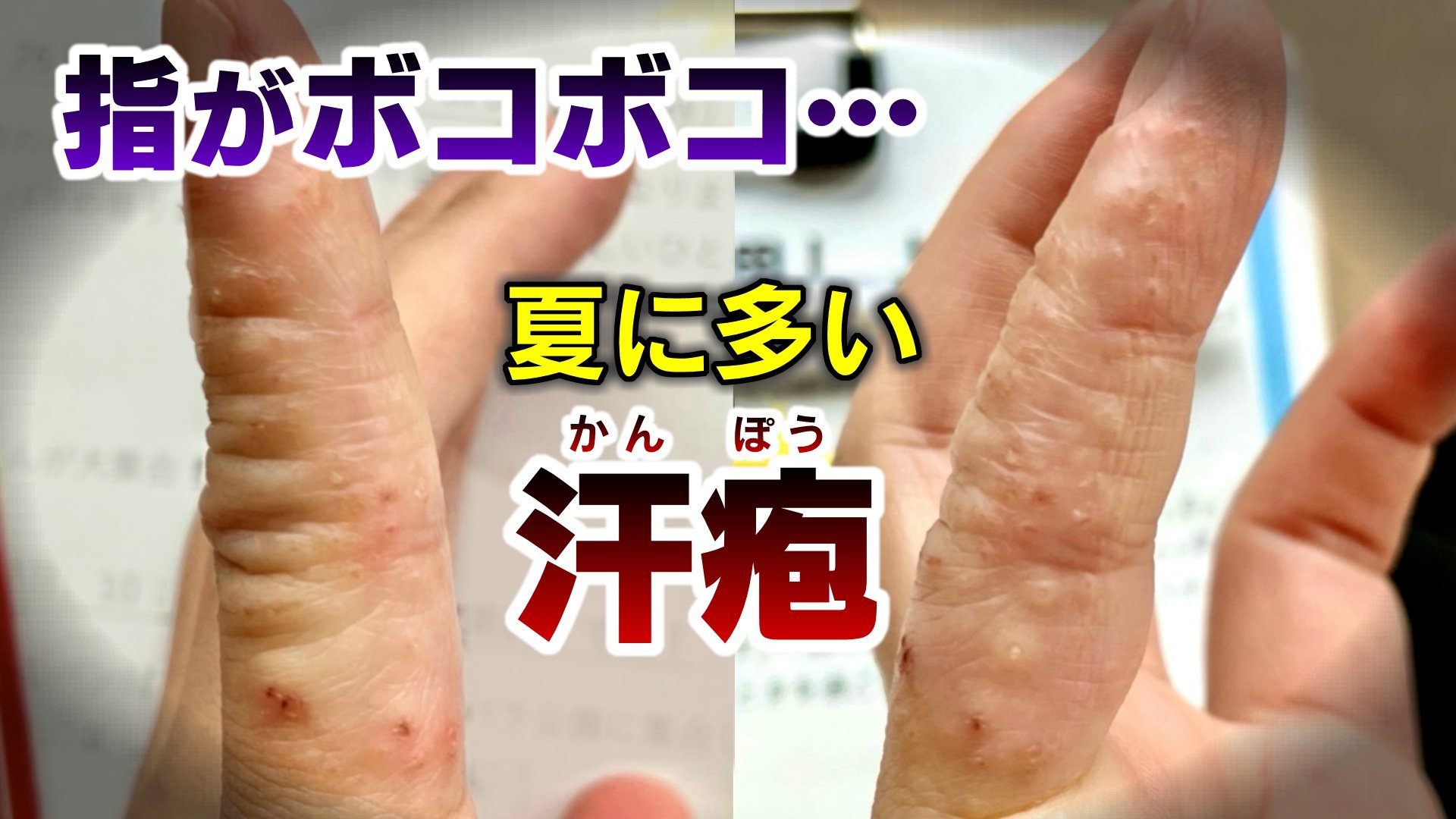 指の水ぶくれの原因と治し方！痒い・痛い症状別の鑑別と最新ケア