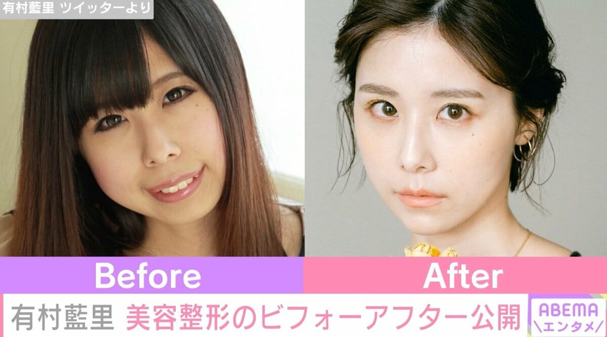 有村藍里が整形を公表した真実｜骨切り手術の費用と現在の姿を追う