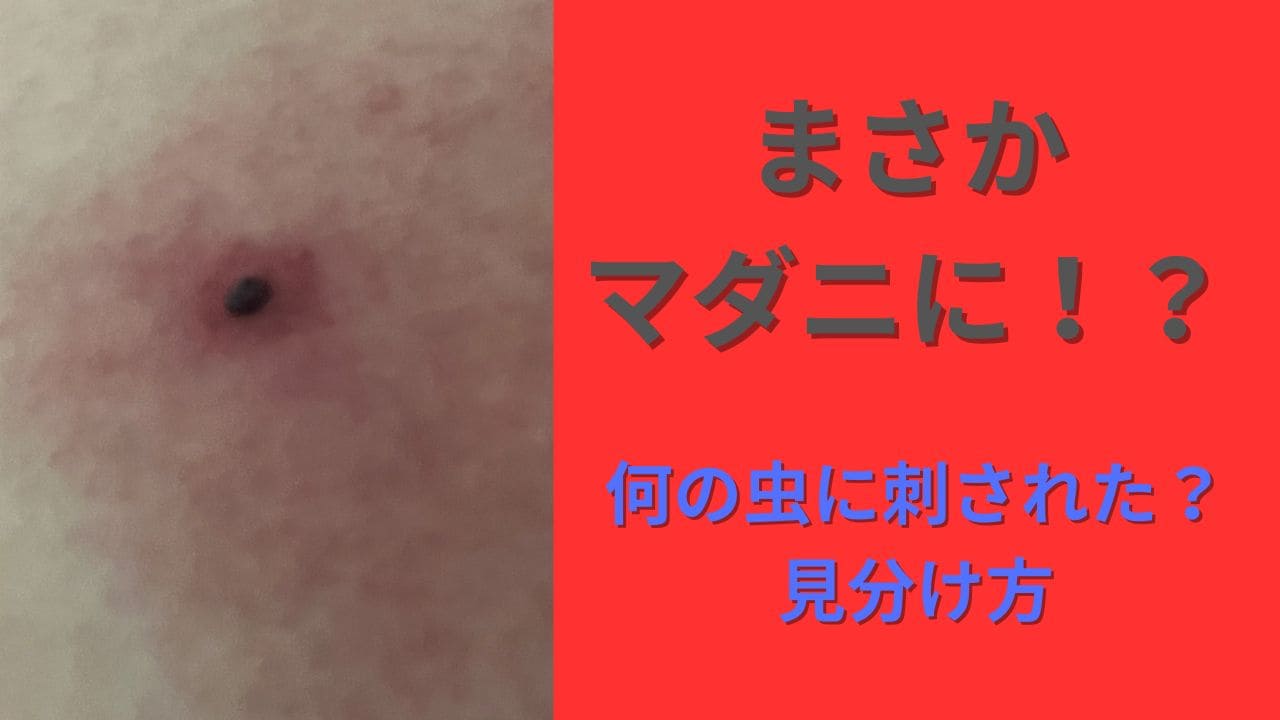 【放置厳禁】マダニに刺された跡の危険サインは？絶対Ngな対処法と見分け方