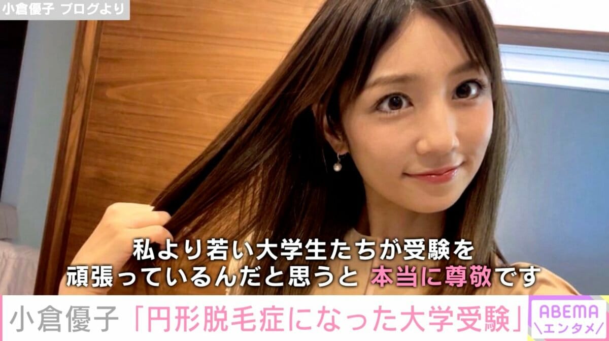 円形脱毛症を告白した芸能人まとめ！壮絶な重圧と克服の真相【2026】