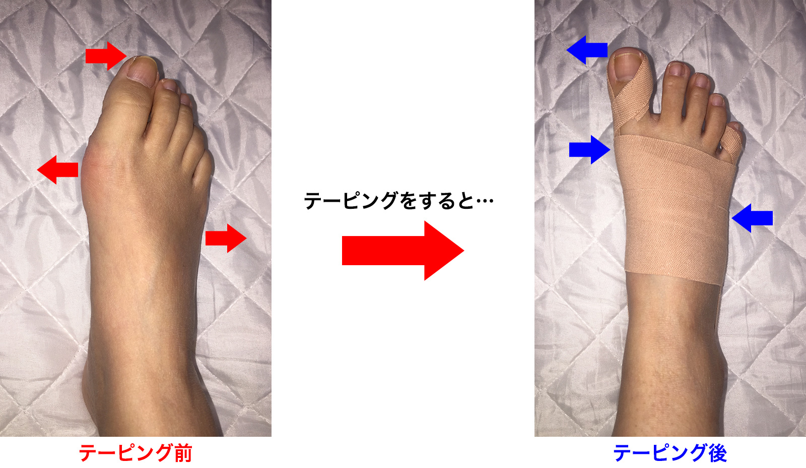 外反母趾はテーピングで治る？骨の変形の真相と痛みを防ぐ正しい対処法