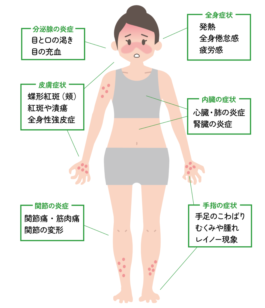 微熱・関節痛は膠原病の症状？医師が教える見逃せない7つのサイン