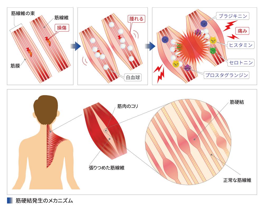 筋硬結とは？筋肉のしこりの原因と放置の危険性・最新の治し方