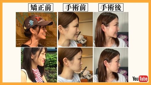 【速報】 顎 変形 症 芸能人 最新ニュース速報 2026 #645