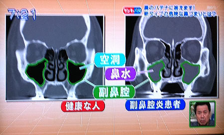 鬼滅の刃カナヲの失明理由と炭治郎との結婚の真相！壮絶な過去とその後