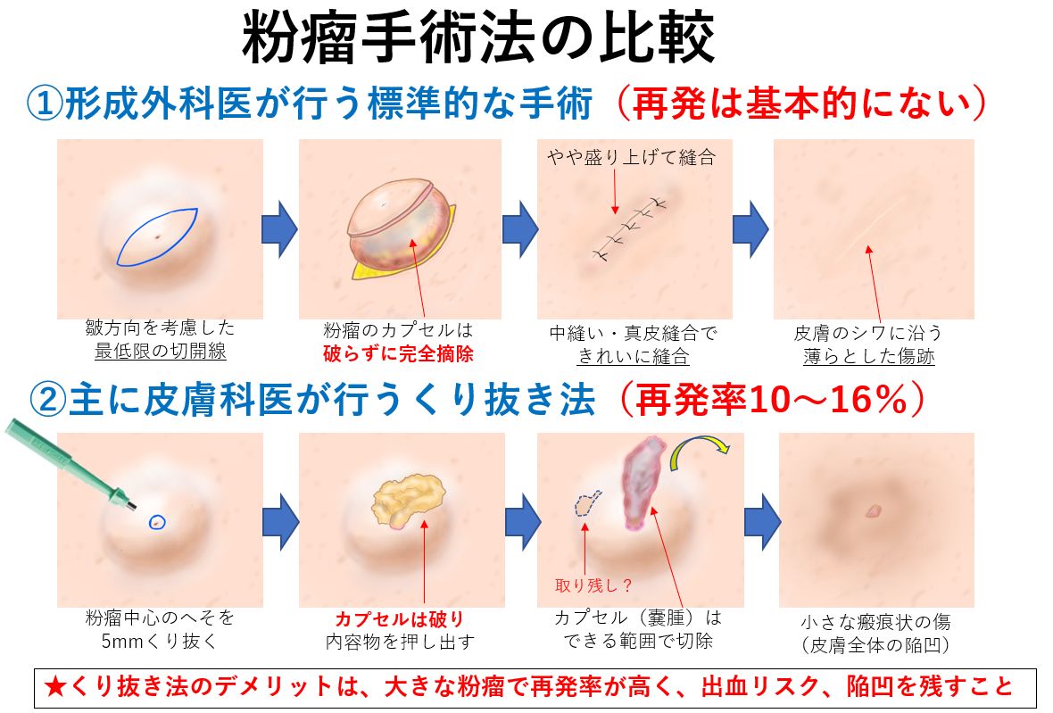 粉瘤の治し方完全ガイド｜自分で治せる？手術費用と最新治療法