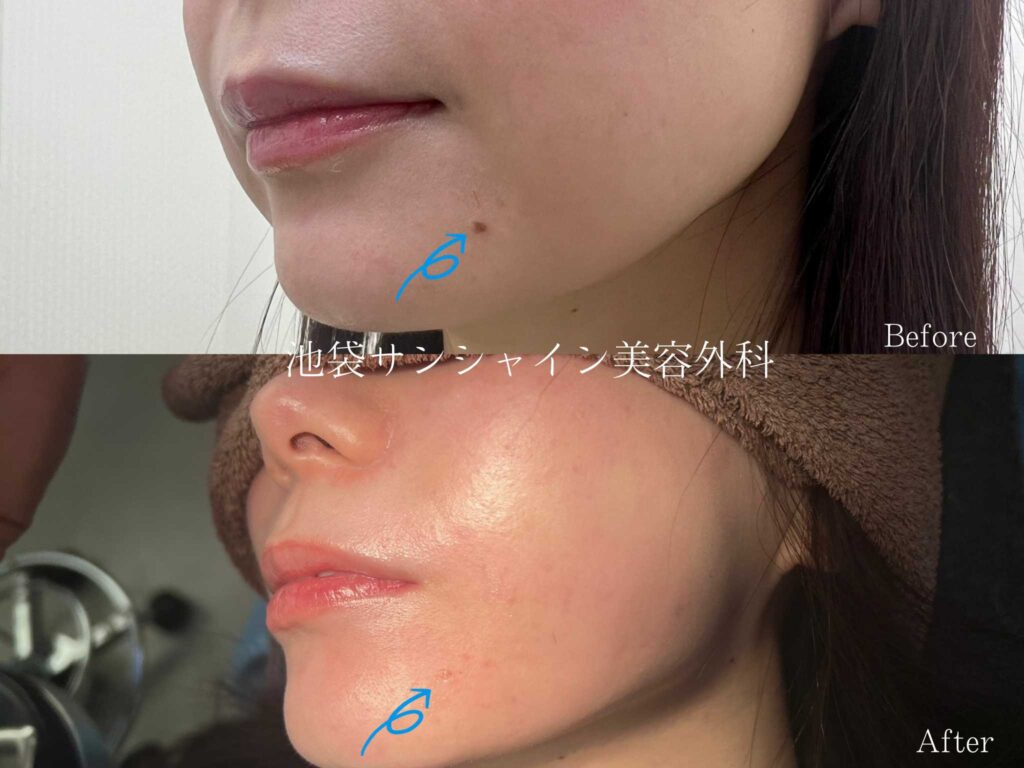 ほくろの毛を抜いてはいけない理由とは？太い原因と正しい処理法