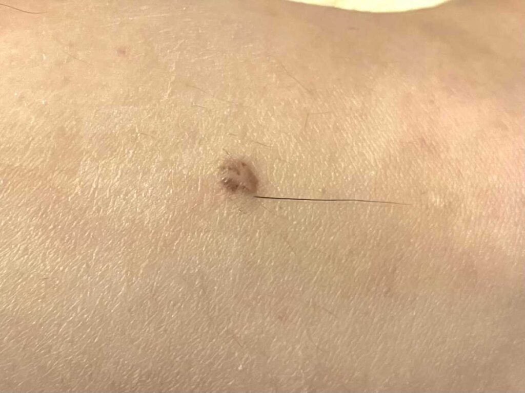 ほくろから毛が生える理由と抜く危険性｜癌の噂の真相と正しい対処法