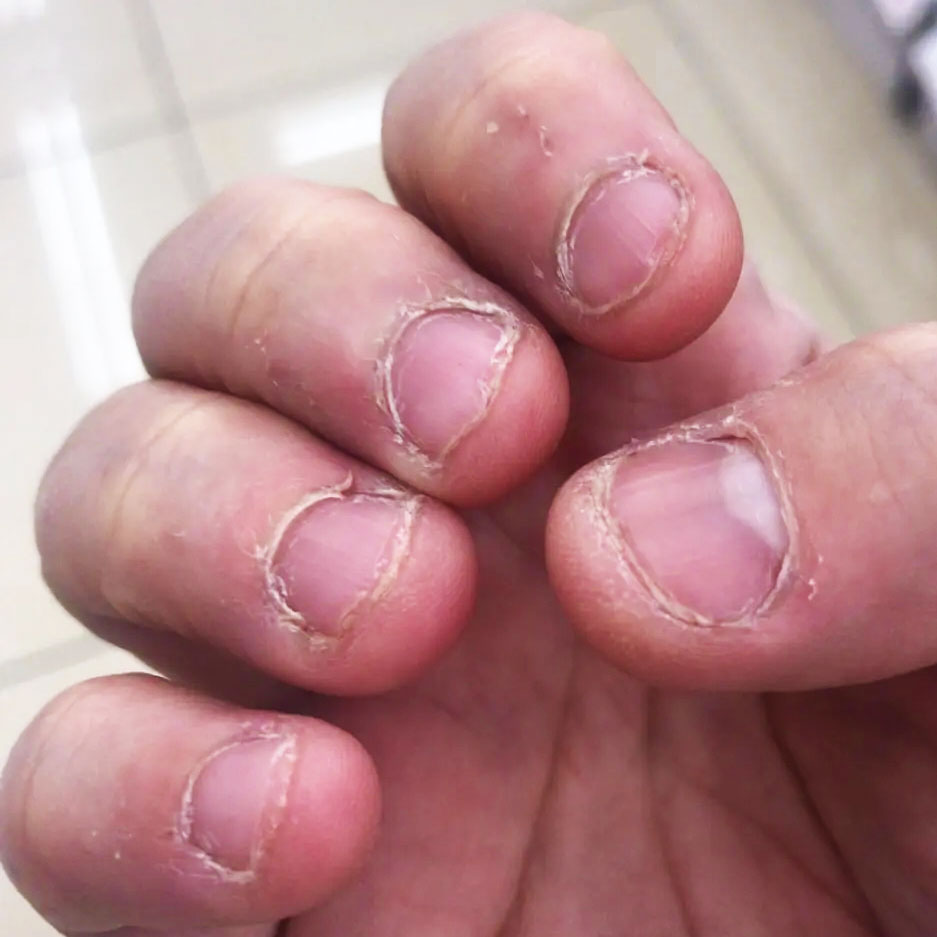 爪を噛む大人は病気なのか？心理的要因とAdhdの真相・具体的改善策