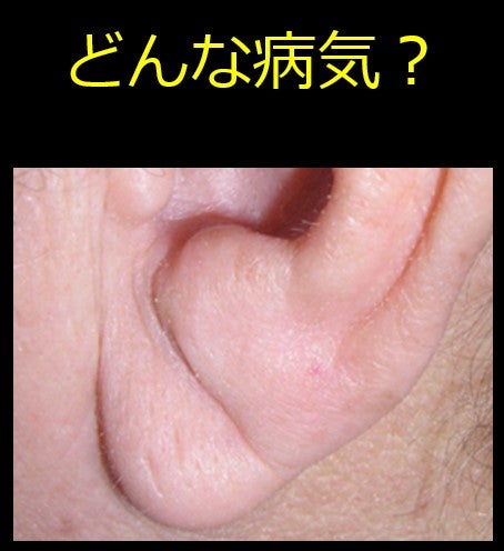 【話題】 動脈 硬化 耳たぶ 画像 私服＆私生活最新ショット #646