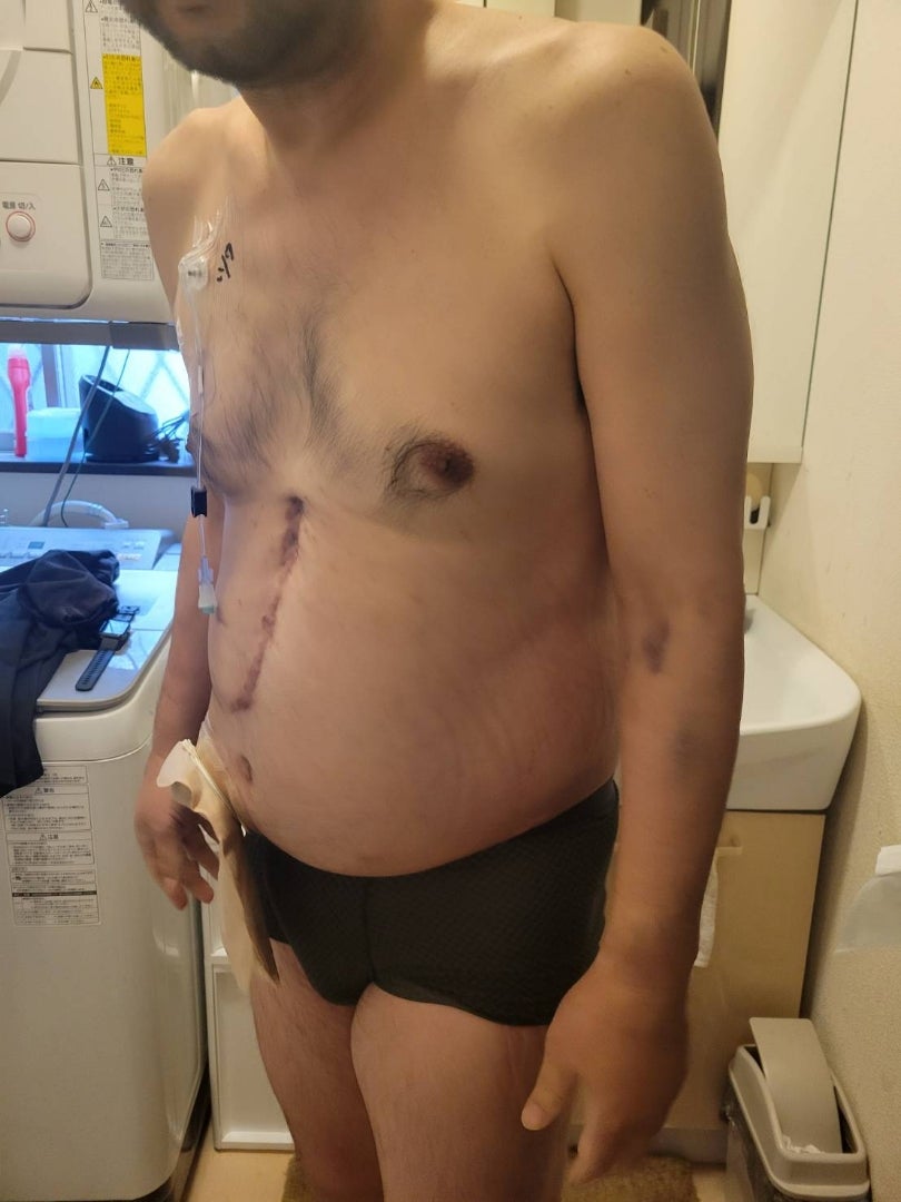 腹水が出たら余命1ヶ月は本当か？末期症状の真実と苦痛を和らげる選択肢