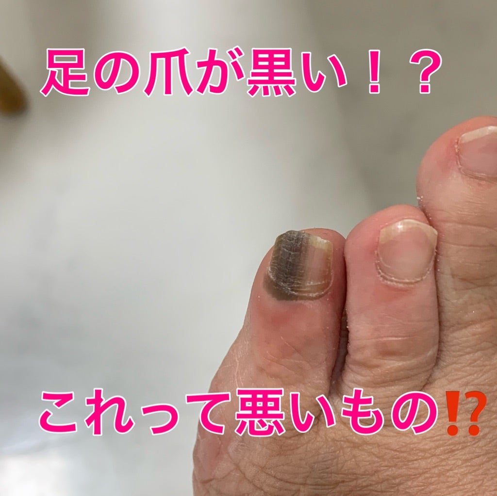 爪の黒い線はメラノーマ？ほくろとの見分け方と写真で見る危険サイン