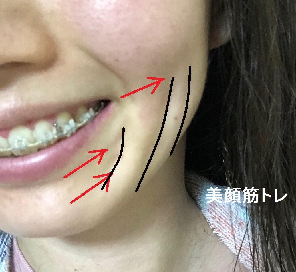 笑うと目立つ口の横のしわ！たるみの真相と2026年最新の改善策