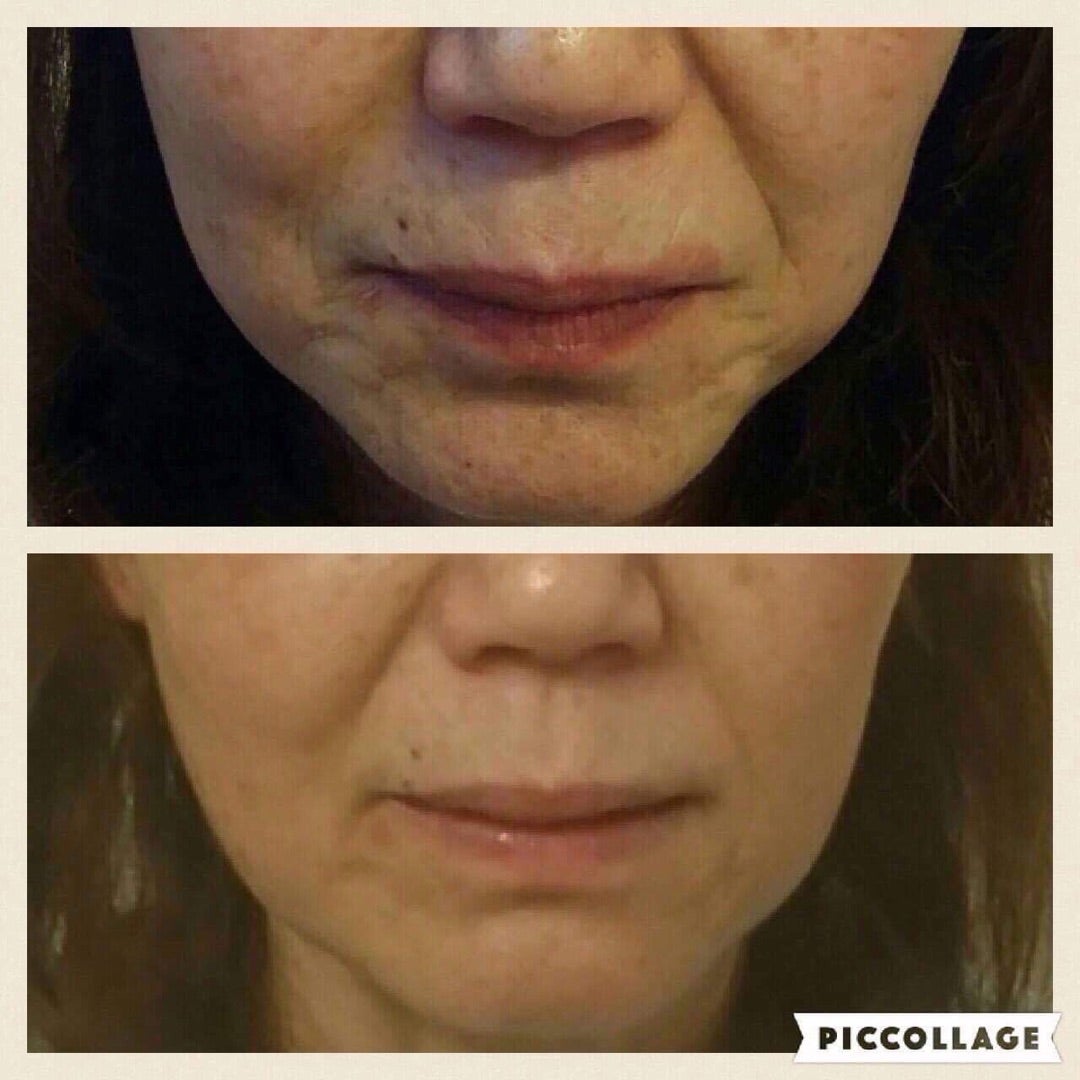 コラーゲンマシンの効果は嘘？肌と髪の変化や通う頻度の真相を徹底解剖