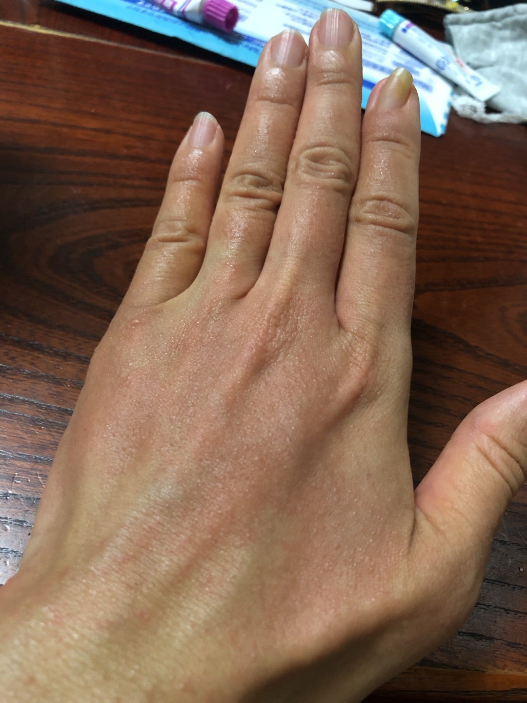 指先の痒みと水疱は警告！レジンアレルギー初期症状の真相と防護対策
