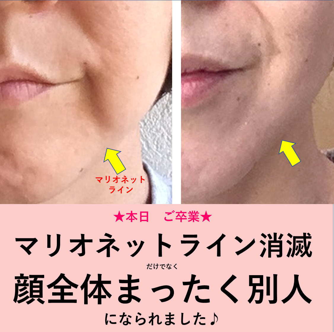 マリオネットラインが消えた人の実態！自力改善と美容医療の境界線