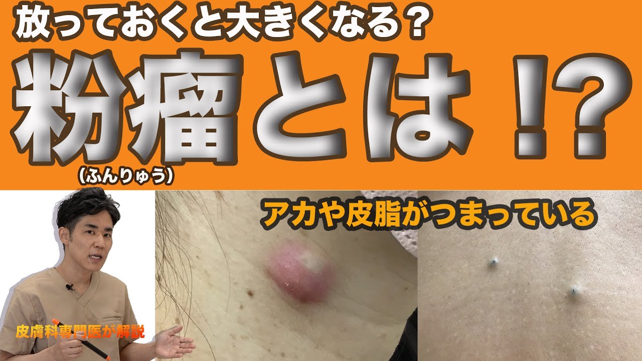 悪性リンパ腫のしこり写真と特徴｜触った硬さ・痛みの有無と受診目安