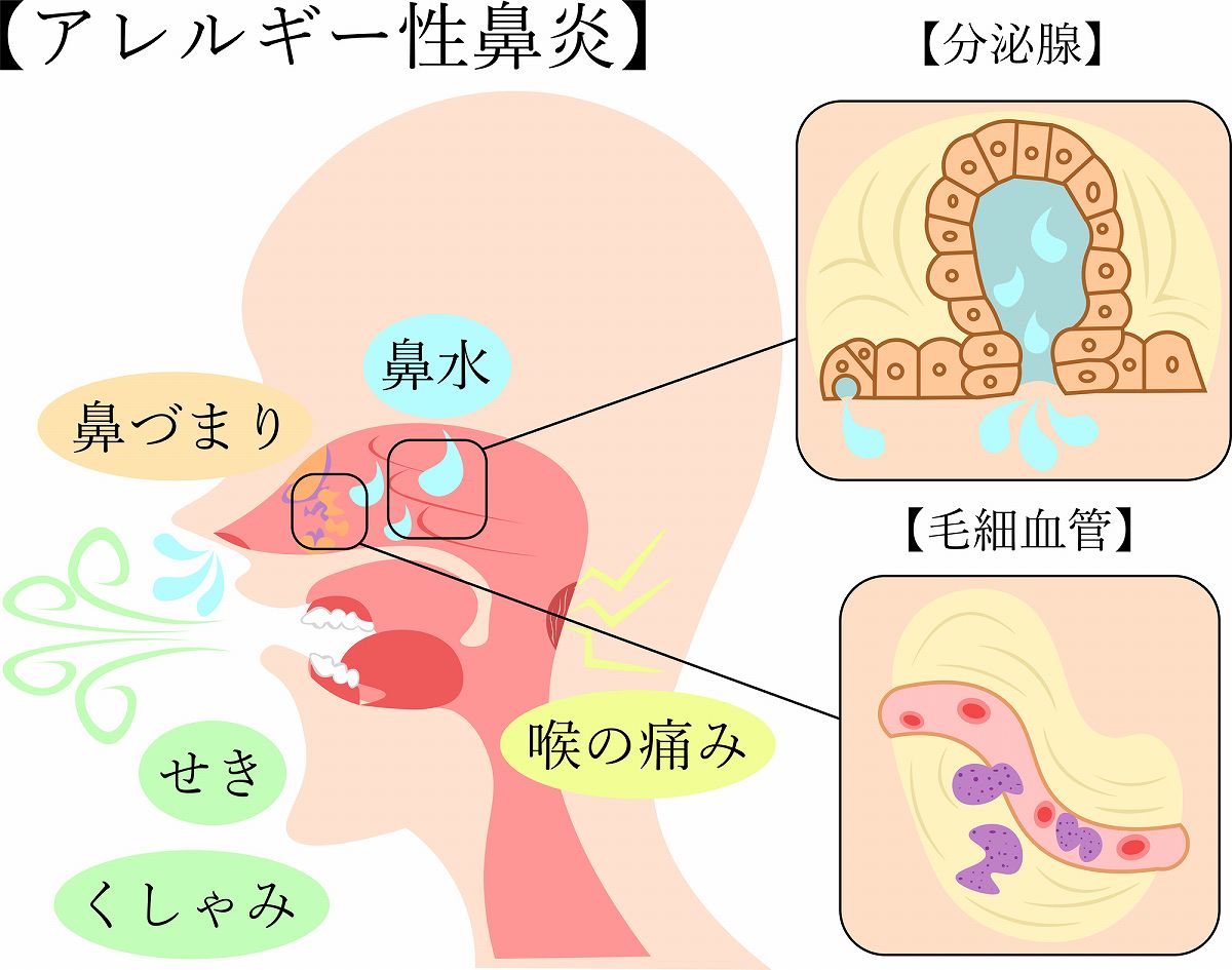 透明な鼻水が止まらない原因は？風邪とアレルギーの見分け方と受診目安