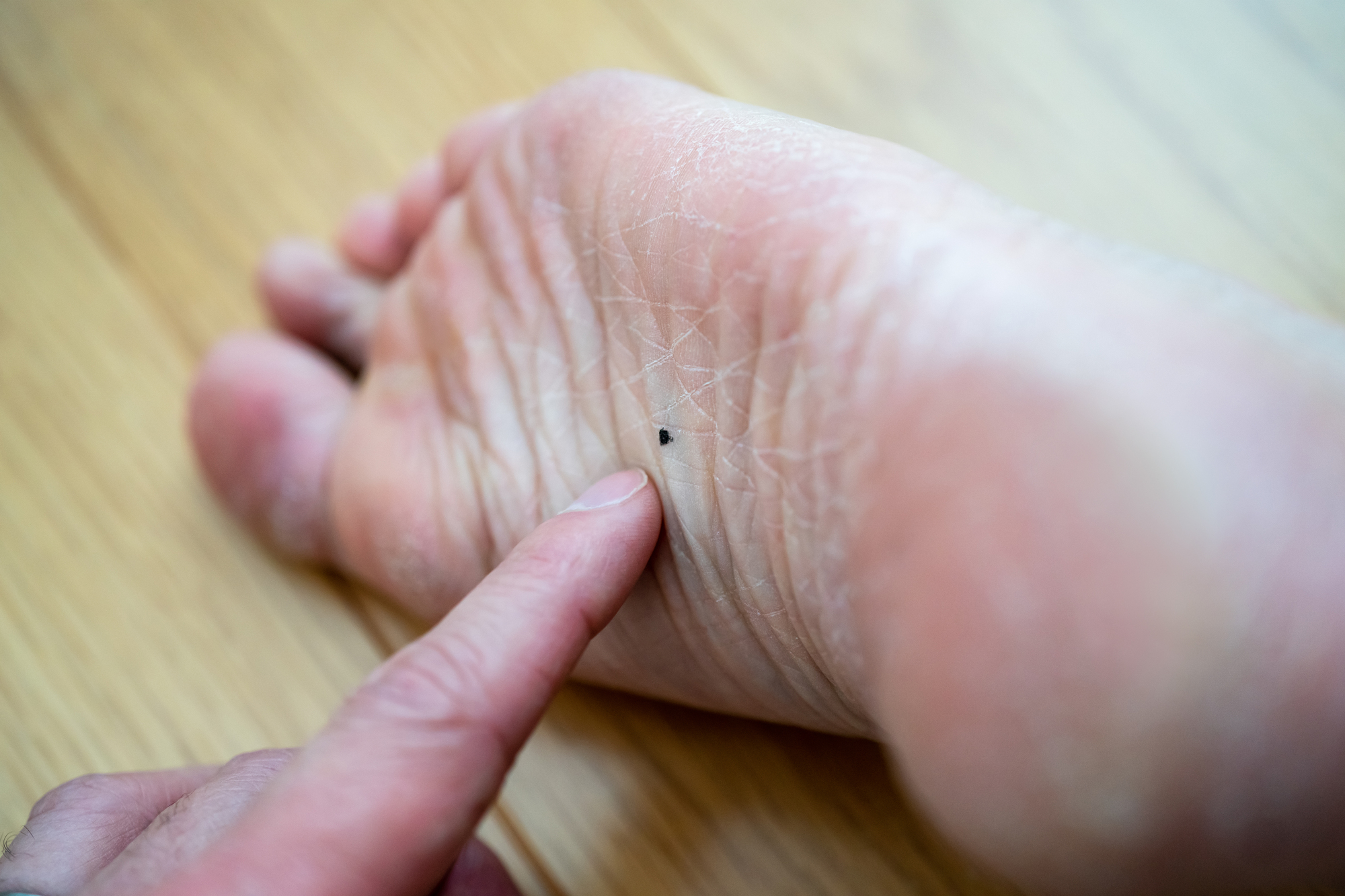 足の裏のほくろは癌？メラノーマの見分け方と危険なサインを徹底解説