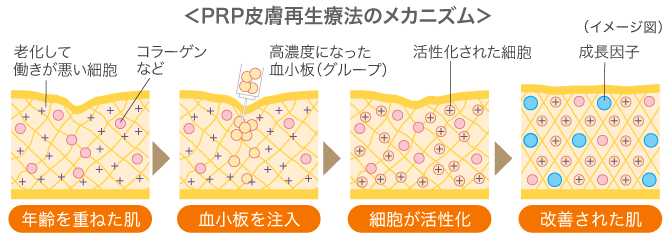 Prp皮膚再生療法ブログを総力検証！膨らみすぎの罠と名医選び