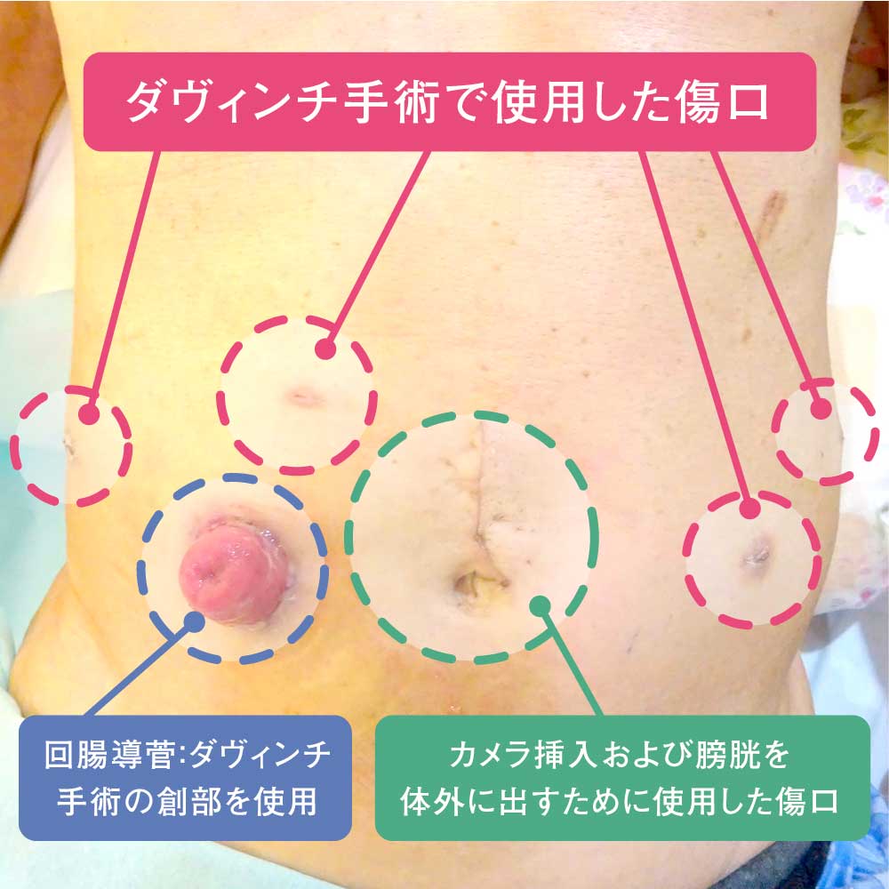 回腸導管造設術の全貌｜術後生活の変化・合併症リスクと正しいケア