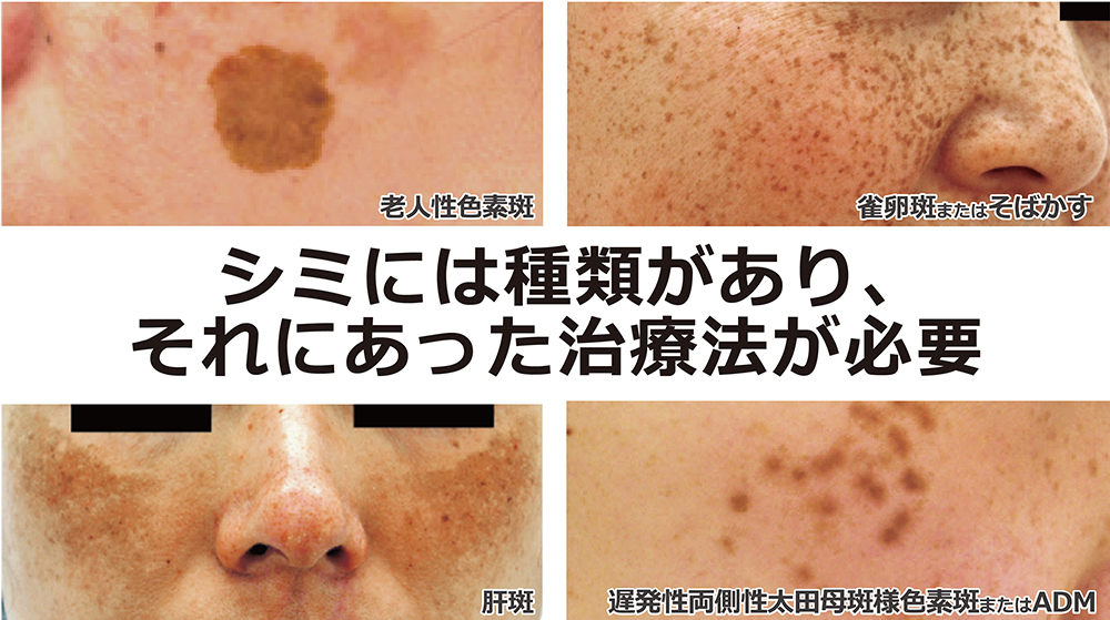 ドラッグストアのシミ対策美容液！2026年本当に効く名品を徹底検証