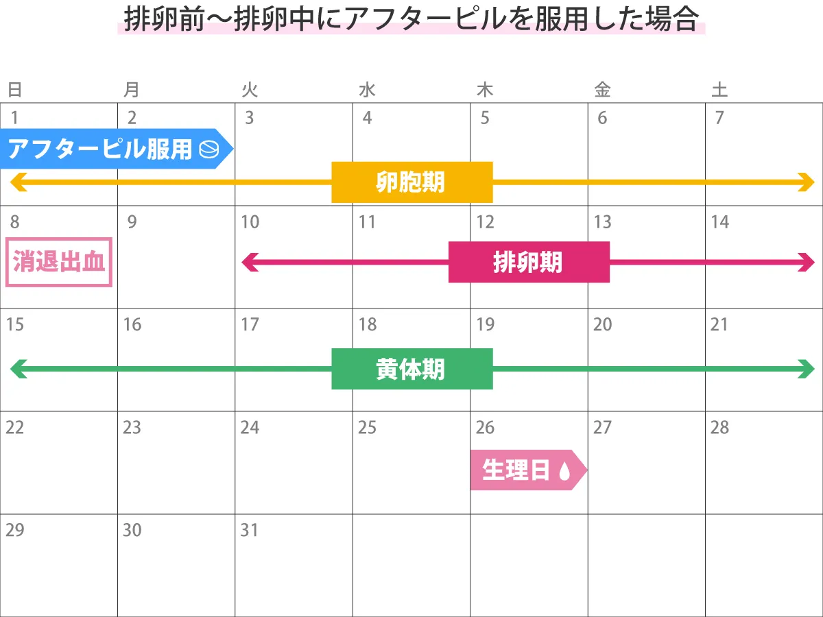 アフターピルの消退出血と着床出血の違い｜時期と量で見抜く避妊成否