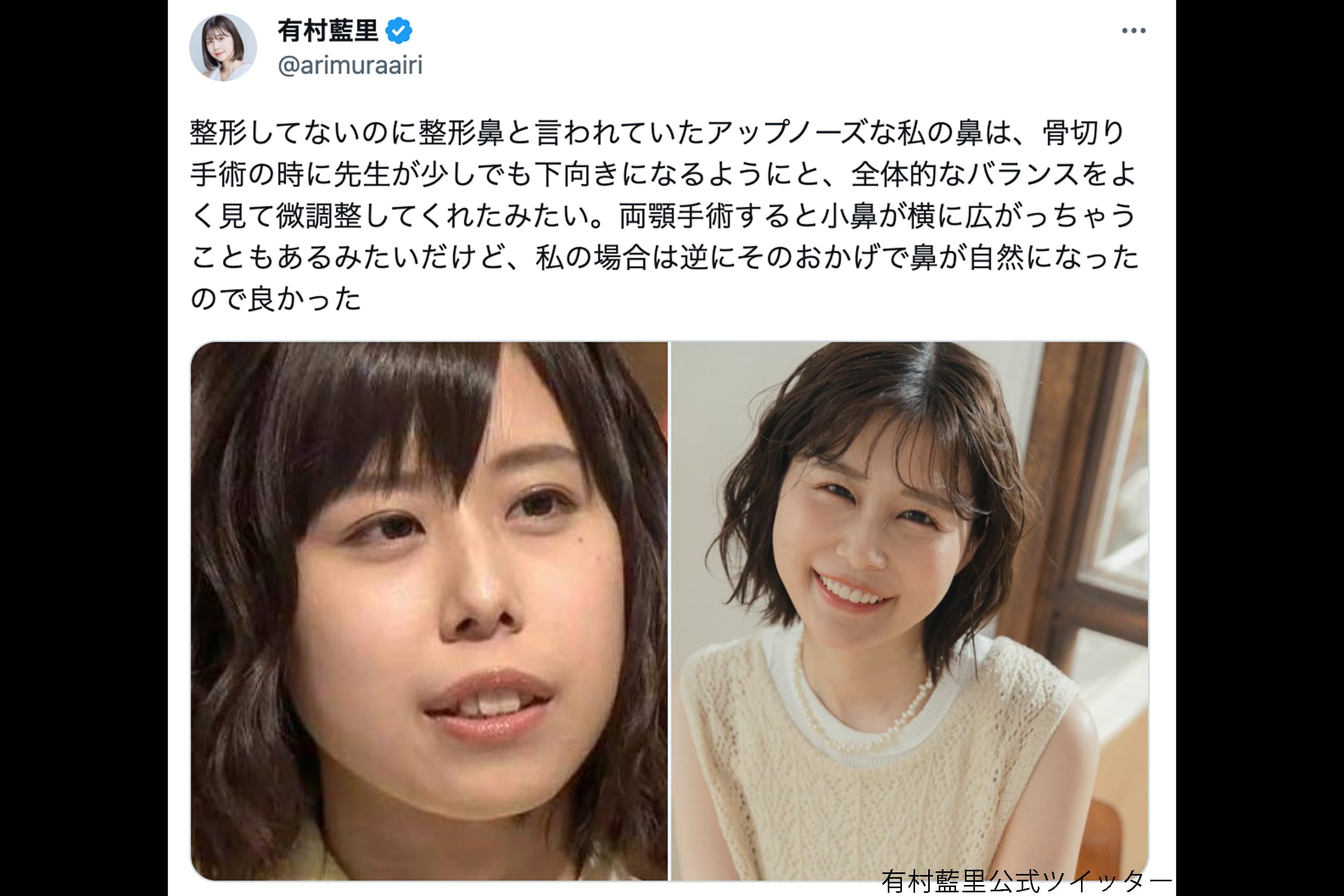 有村藍里の整形ビフォーアフター｜骨切り費用と執刀医・公表の真相