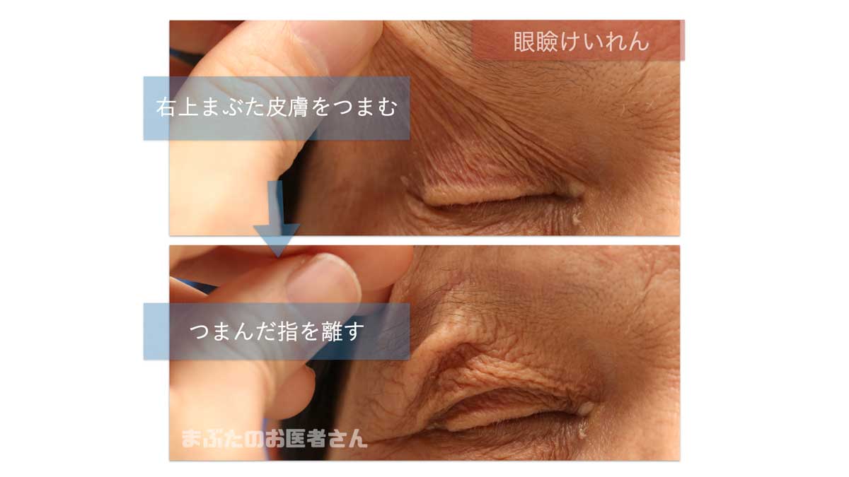 まぶたが痙攣する原因と危険な病気のサイン｜専門医が明かす最新治療