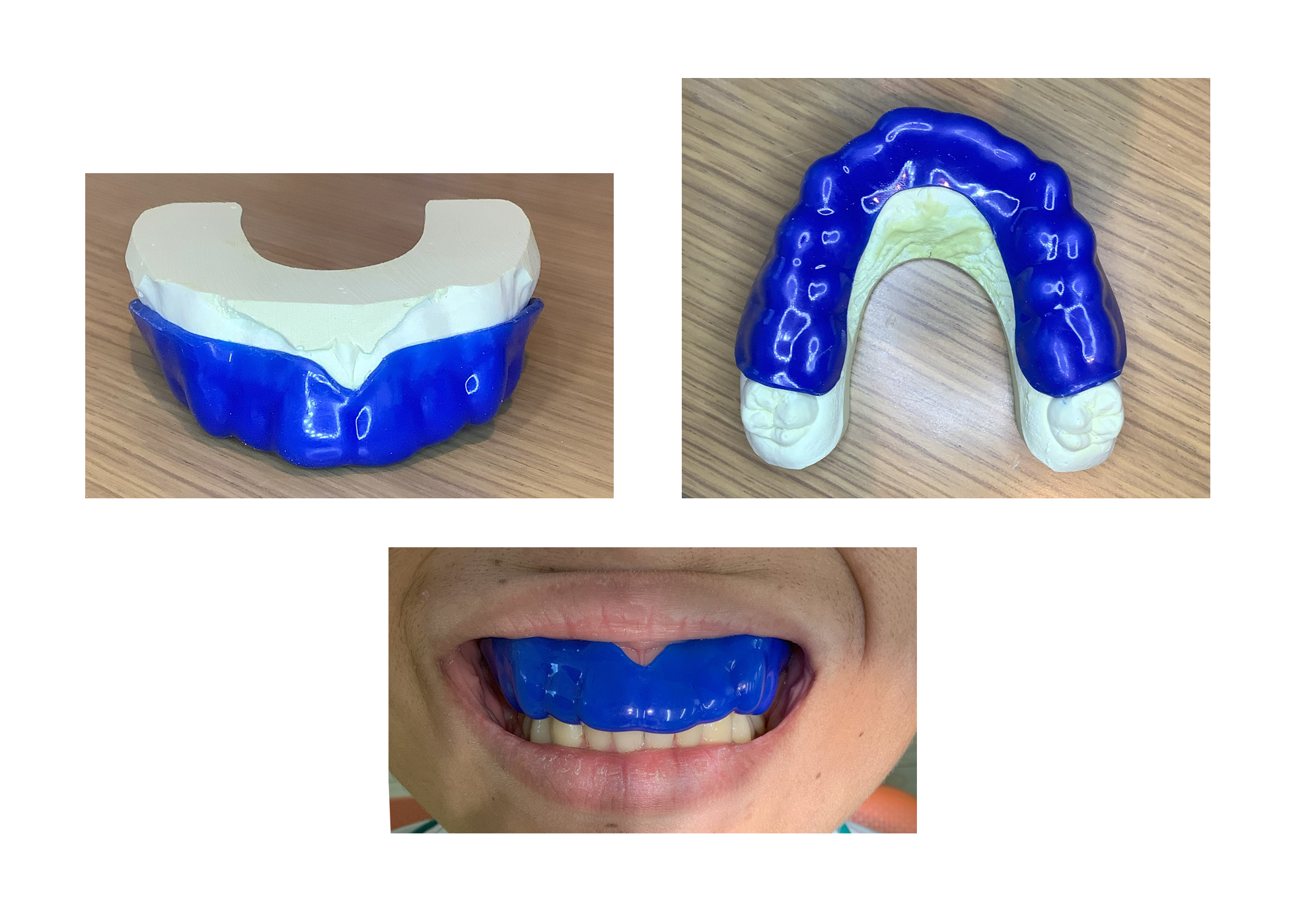 スポーツマウスピースの真実｜市販と特注の格差と筋力向上メカニズム