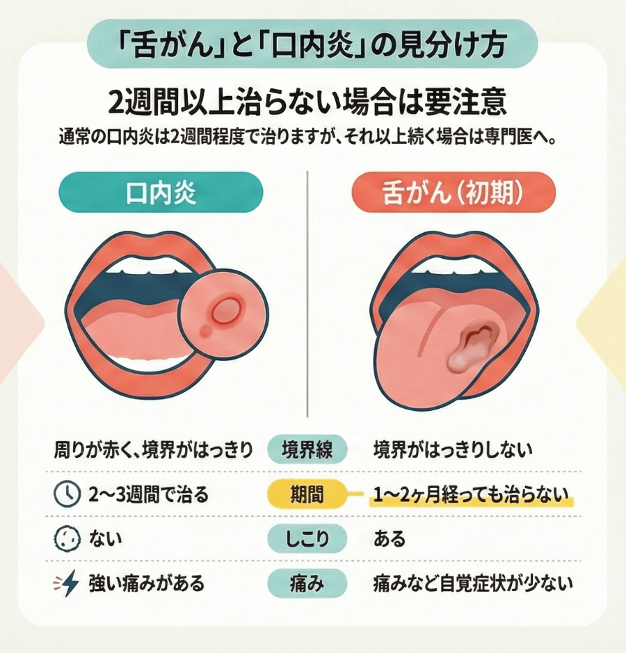 口内炎と舌癌の決定的な違いとは？2週間治らないしこりの見分け方