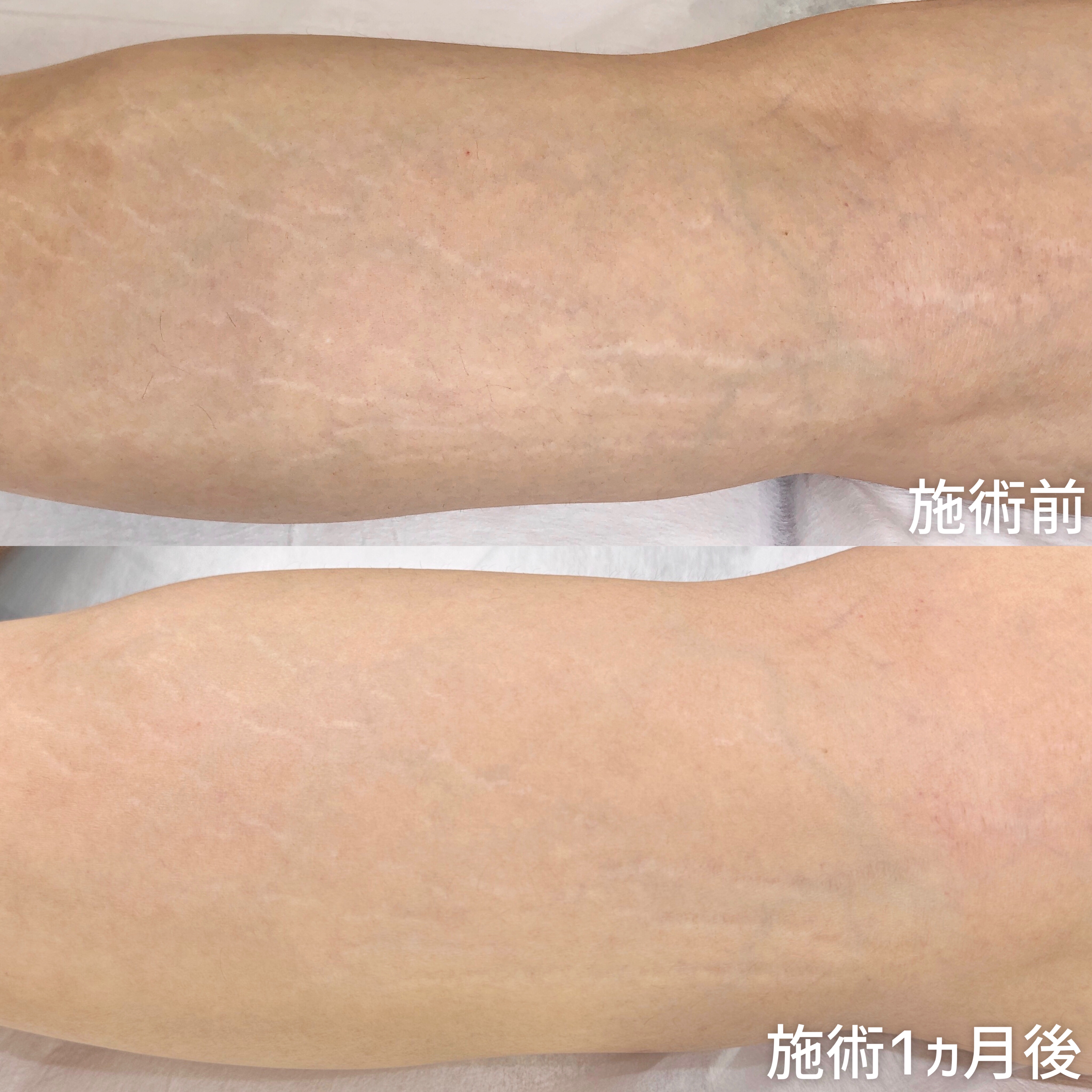 ふくらはぎの肉割れはなぜ消えない？原因と最新の消す方法を徹底解明